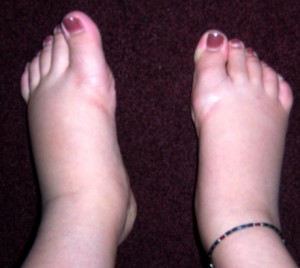 swollen-feet1