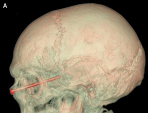 This undated image provided by the New England Journal of Medicine on May 12, 2015 shows a CT scan with a nail in the eye of a patient. Boston doctors removed the nearly 3-inch nail after it hurtled into the eye of a 27-year-old landscaper when he accidentally hit it with a weed-whacking tool. A checkup eight weeks later showed his vision had returned to normal. (AP Photo/New England Journal of Medicine)