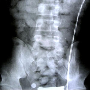 Body Scan Showing The Pellets In Chiedozie's System