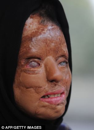 SCARRED: SONALI HAS UNDERGONE 22 SURGERIES SINCE THE 2003 ATTACK WHICH SAW HER LOSE MOST OF HER FACIAL FEATURES. SHE IS PARTIALLY BLIND AND DEAF AS A RESULT OF HER INJURIES.