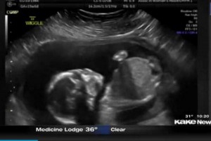 Fetus-punches-himself-in-the-face-in-ultrasound-footage