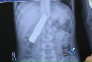 10-year-old Boy With Stomach flu Discovered To Have Swallowed 10 Magnets