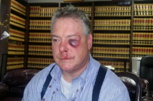 This March 9, 2016 photo provided by Jerry L. Steering shows Defense attorney James Crawford at his attorney's office in Newport Beach, Calif. Crawford an Orange County defense attorney who suffered a bloodied face after a brawl with a district attorney's investigator in a Santa Ana courthouse hallway. Crawford was speaking with a witness in the courthouse Wednesday, March 9, when an investigator he did not know interrupted his conversation and called defense lawyers sleazy, said Jerry Steering, Crawford's lawyer. (Jerry L. Steering via AP)
