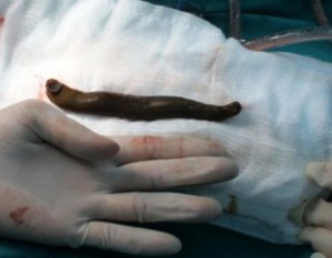 The leech removed from the boy's bladder