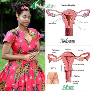 uterine-fibroid-testimony