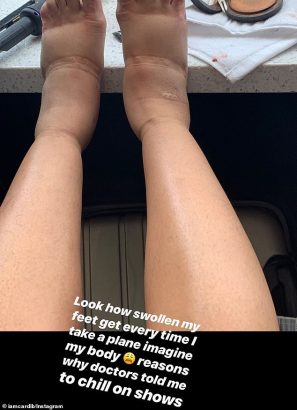 [Photo]: Cardi B shares a photo of her swollen leg following aftermath of her plastic surgery