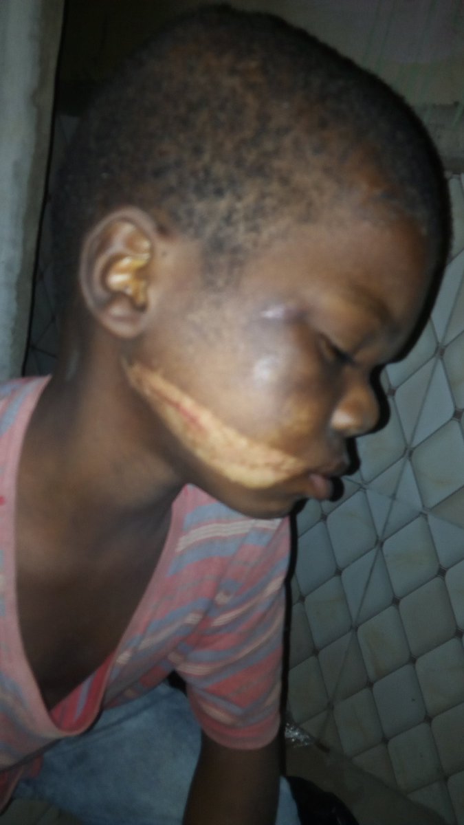 Shocking!!! Father Disfigures Son's Jaw With Hot Knife Foe Stealing Meat From Pot