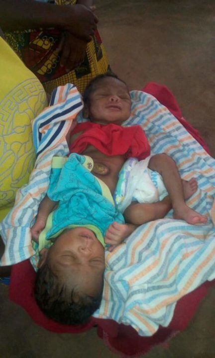 [Photos]: Woman Gives Birth To Conjoined Twins In Benue State