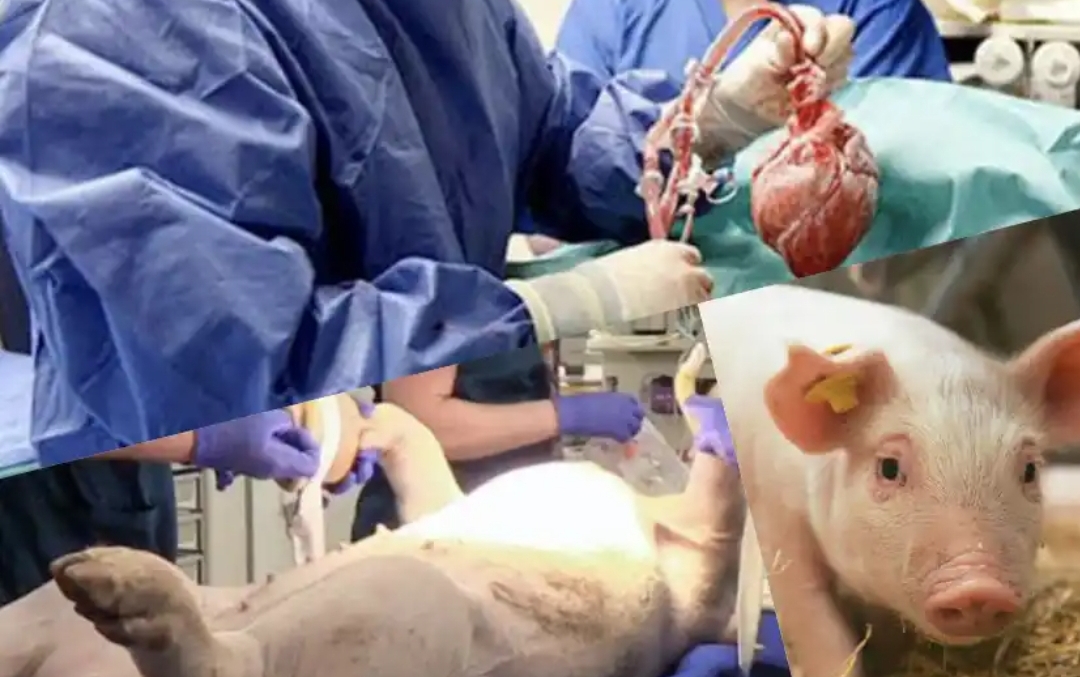 Second US pig to human transplant 